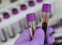 Lions Club Urges FG To Make Diabetes Screening Mandatory