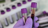 Scientists Develop Revolutionary Blood Test To Detect Diabetic Complications Early, Accurately