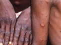 News Cases Of Monkeypox Hits Lagos, Rivers, Akwa Ibom