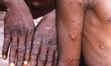 News Cases Of Monkeypox Hits Lagos, Rivers, Akwa Ibom